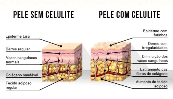 Entendendo a celulite